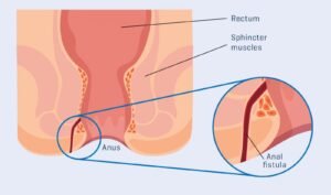 Anal Fistula Treatment In Jayanagar Dr Gaurang Ramesh