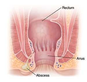 anorectal abscess treatment in JP Nagar