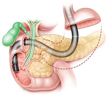 ERCP treatment in JP Nagar