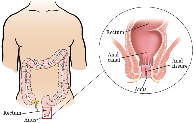 Anal fissure treatment in JP Nagar