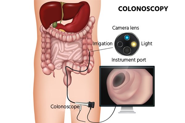 Colonoscopy treatment in JP Nagar