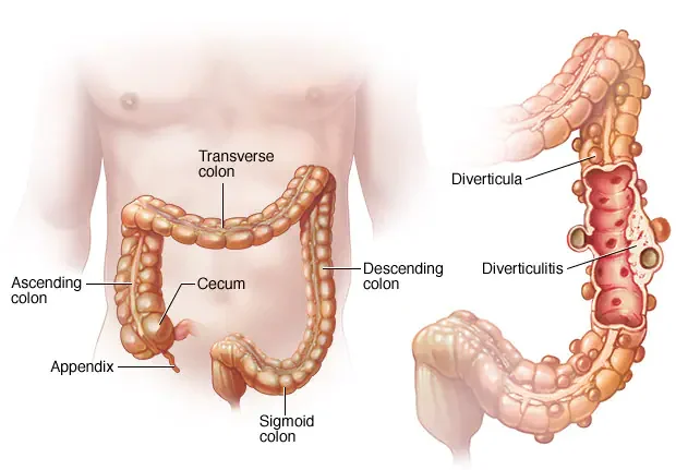 Diverticulitis treatment in Jayanagar