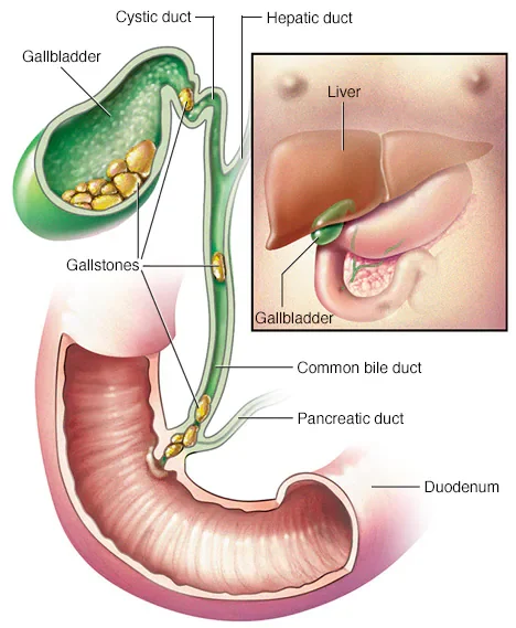 Gallbladder stone removal in JP Nagar