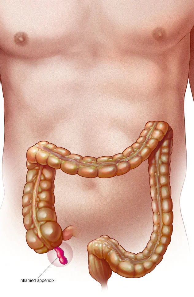 Appendicitis treatment in Jayanagar