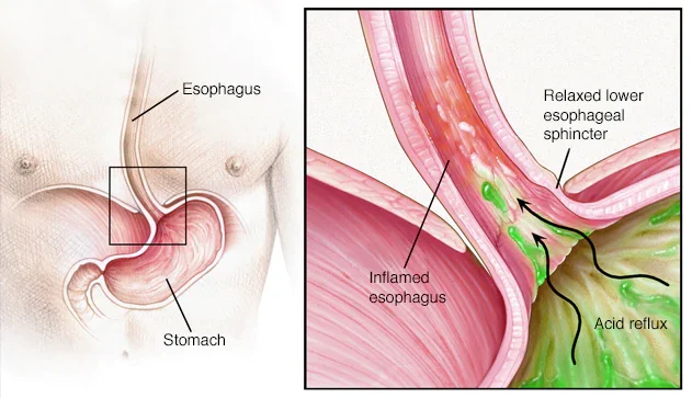 GERD treatment in JP Nagar