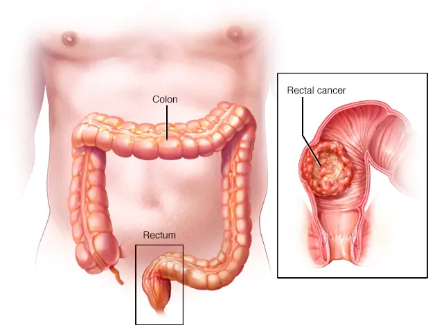 Rectal cancer treatment in JP Nagar